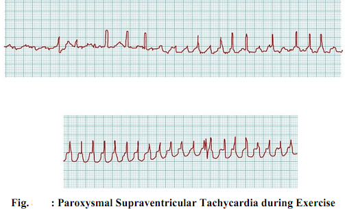 554_Atrial Fibrillation or Flutter.png